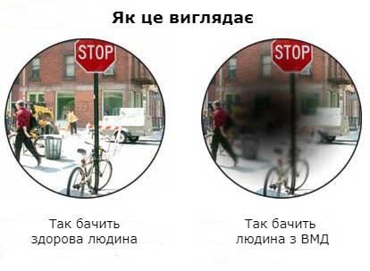 Як бачить людина з ВМД Як бачить людина з ВМД